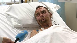 Врачи-комбустиологи спасают жизни: как эвакуация помогает пострадавшим с ожогами