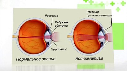 Рубрика "PRO здоровье": астигматизм