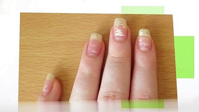 Рубрика "PRO здоровье": знаки на ногтях